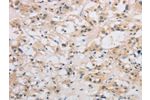 The image on the left is immunohistochemistry of paraffin-embedded Human thyroid cancer tissue using CSB-PA049554(DDIT4L Antibody) at dilution 1/40, on the right is treated with fusion protein. (Original magnification: 