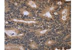 The image on the left is immunohistochemistry of paraffin-embedded Human colon cancer tissue using CSB-PA049737(FGFR1OP2 Antibody) at dilution 1/40, on the right is treated with fusion protein. (Original magnification: 