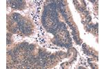 The image on the left is immunohistochemistry of paraffin-embedded Human colon cancer tissue using CSB-PA050337(FAIM Antibody) at dilution 1/25, on the right is treated with synthetic peptide. (Original magnification: 