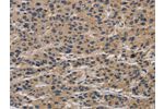 The image on the left is immunohistochemistry of paraffin-embedded Human liver cancer tissue using CSB-PA050929(CLEC2A Antibody) at dilution 1/20, on the right is treated with synthetic peptide. (Original magnification: 