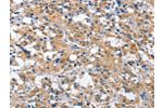 The image on the left is immunohistochemistry of paraffin-embedded Human thyroid cancer tissue using CSB-PA051064(CUL7 Antibody) at dilution 1/35, on the right is treated with fusion protein. (Original magnification: 