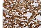 The image on the left is immunohistochemistry of paraffin-embedded Human thyroid cancer tissue using CSB-PA051134(CLDN2 Antibody) at dilution 1/30, on the right is treated with synthetic peptide. (Original magnification: 