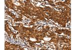 The image on the left is immunohistochemistry of paraffin-embedded Human gastic cancer tissue using CSB-PA051152(CYP2D6 Antibody) at dilution 1/30, on the right is treated with synthetic peptide. (Original magnification: 