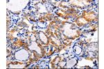 The image on the left is immunohistochemistry of paraffin-embedded Human thyroid cancer tissue using CSB-PA051525(AP1B1 Antibody) at dilution 1/100, on the right is treated with synthetic peptide. (Original magnification: 
