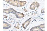 The image on the left is immunohistochemistry of paraffin-embedded Human colon cancer tissue using CSB-PA051678(ABHD1 Antibody) at dilution 1/15, on the right is treated with fusion protein. (Original magnification: 