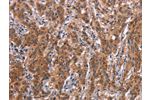 The image on the left is immunohistochemistry of paraffin-embedded Human gastic cancer tissue using CSB-PA051790(FDCSP Antibody) at dilution 1/25, on the right is treated with synthetic peptide. (Original magnification: 