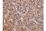 The image on the left is immunohistochemistry of paraffin-embedded Human liver cancer tissue using CSB-PA051887(ADM2 Antibody) at dilution 1/40, on the right is treated with synthetic peptide. (Original magnification: 