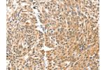 The image on the left is immunohistochemistry of paraffin-embedded Human esophagus cancer tissue using CSB-PA052042(BAX Antibody) at dilution 1/30, on the right is treated with fusion protein. (Original magnification: 