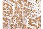 The image on the left is immunohistochemistry of paraffin-embedded Human colon cancer tissue using CSB-PA052305(CELSR2 Antibody) at dilution 1/50, on the right is treated with synthetic peptide. (Original magnification: 