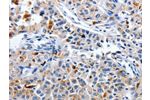 The image on the left is immunohistochemistry of paraffin-embedded Human lung cancer tissue using CSB-PA052625(CDK3 Antibody) at dilution 1/30, on the right is treated with synthetic peptide. (Original magnification: 
