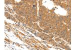 The image on the left is immunohistochemistry of paraffin-embedded Human liver cancer tissue using CSB-PA053077(DOPEY1 Antibody) at dilution 1/25, on the right is treated with synthetic peptide. (Original magnification: 