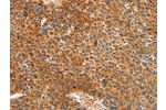 The image on the left is immunohistochemistry of paraffin-embedded Human liver cancer tissue using CSB-PA053602(ALDH1A2 Antibody) at dilution 1/30, on the right is treated with synthetic peptide. (Original magnification: 