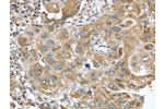 The image on the left is immunohistochemistry of paraffin-embedded Human esophagus cancer tissue using CSB-PA053884(DNAJA3 Antibody) at dilution 1/25, on the right is treated with fusion protein. (Original magnification: 