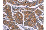 The image on the left is immunohistochemistry of paraffin-embedded Human breast cancer tissue using CSB-PA053903(FST Antibody) at dilution 1/20, on the right is treated with synthetic peptide. (Original magnification: 