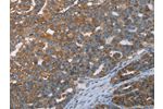 The image on the left is immunohistochemistry of paraffin-embedded Human ovarian cancer tissue using CSB-PA054139(CERS4 Antibody) at dilution 1/35, on the right is treated with synthetic peptide. (Original magnification: 