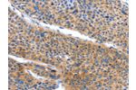 The image on the left is immunohistochemistry of paraffin-embedded Human liver cancer tissue using CSB-PA054255(ARL11 Antibody) at dilution 1/50, on the right is treated with fusion protein. (Original magnification: 