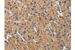 The image on the left is immunohistochemistry of paraffin-embedded Human liver cancer tissue using CSB-PA055165(CEACAM3 Antibody) at dilution 1/70, on the right is treated with fusion protein. (Original magnification: 