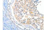 The image on the left is immunohistochemistry of paraffin-embedded Human breast cancer tissue using CSB-PA055199(DUSP14 Antibody) at dilution 1/20, on the right is treated with fusion protein. (Original magnification: 