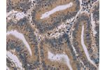 The image on the left is immunohistochemistry of paraffin-embedded Human colon cancer tissue using CSB-PA055681(ACVR2A Antibody) at dilution 1/20, on the right is treated with synthetic peptide. (Original magnification: 