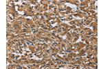 The image on the left is immunohistochemistry of paraffin-embedded Human thyroid cancer tissue using CSB-PA055744(BMP15 Antibody) at dilution 1/40, on the right is treated with fusion protein. (Original magnification: 