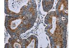 The image on the left is immunohistochemistry of paraffin-embedded Human colon cancer tissue using CSB-PA055799(ELAVL3 Antibody) at dilution 1/20, on the right is treated with synthetic peptide. (Original magnification: 