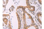 The image on the left is immunohistochemistry of paraffin-embedded Human colon cancer tissue using CSB-PA056130(ADCY1 Antibody) at dilution 1/60, on the right is treated with synthetic peptide. (Original magnification: 