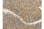 The image on the left is immunohistochemistry of paraffin-embedded Human liver cancer tissue using CSB-PA056430(ACLY Antibody) at dilution 1/40, on the right is treated with fusion protein. (Original magnification: 