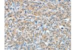 The image on the left is immunohistochemistry of paraffin-embedded Human esophagus cancer tissue using CSB-PA056537(BAG3 Antibody) at dilution 1/20, on the right is treated with fusion protein. (Original magnification: 
