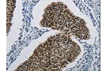 The image on the left is immunohistochemistry of paraffin-embedded Human cervical cancer tissue using CSB-PA056628(DDB1 Antibody) at dilution 1/5, on the right is treated with synthetic peptide. (Original magnification: 
