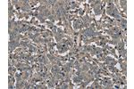 The image on the left is immunohistochemistry of paraffin-embedded Human liver cancer tissue using CSB-PA056820(FBP1 Antibody) at dilution 1/30, on the right is treated with fusion protein. (Original magnification: 