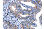 The image on the left is immunohistochemistry of paraffin-embedded Human cervical cancer tissue using CSB-PA056943(AR Antibody) at dilution 1/20, on the right is treated with synthetic peptide. (Original magnification: 