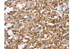 The image on the left is immunohistochemistry of paraffin-embedded Human thyroid cancer tissue using CSB-PA057007(BCL10 Antibody) at dilution 1/40, on the right is treated with fusion protein. (Original magnification: 