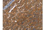 The image on the left is immunohistochemistry of paraffin-embedded Human ovarian cancer tissue using CSB-PA057722(ADAMTS15 Antibody) at dilution 1/40, on the right is treated with fusion protein. (Original magnification: 