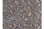 The image on the left is immunohistochemistry of paraffin-embedded Human ovarian cancer tissue using CSB-PA059543(FGF20 Antibody) at dilution 1/20, on the right is treated with synthetic peptide. (Original magnification: 