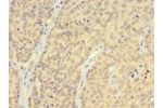 Immunohistochemistry of paraffin-embedded CSB-PA05979A0Rb using human ovarian cancer at dilution 1:100