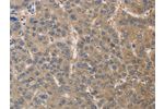 The image on the left is immunohistochemistry of paraffin-embedded Human liver cancer tissue using CSB-PA059973(DPYSL3 Antibody) at dilution 1/30, on the right is treated with fusion protein. (Original magnification: 