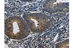 The image on the left is immunohistochemistry of paraffin-embedded Human cervical cancer tissue using CSB-PA060417(CTGF Antibody) at dilution 1/50, on the right is treated with synthetic peptide. (Original magnification: 