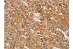 The image on the left is immunohistochemistry of paraffin-embedded Human liver cancer tissue using CSB-PA060806(ART4 Antibody) at dilution 1/50, on the right is treated with synthetic peptide. (Original magnification: 