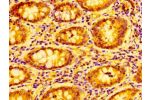 IHC image of CSB-PA06189A0Rb diluted at 1:100 and staining in paraffin-embedded human colon cancer performed on a Leica BondTM system. After dewaxing and hydration, antigen retrieval was mediated by high pressure in a citrate buffer (pH 6.0). Section was 