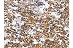 The image on the left is immunohistochemistry of paraffin-embedded Human thyroid cancer tissue using CSB-PA062002(BPI Antibody) at dilution 1/50, on the right is treated with fusion protein. (Original magnification: 