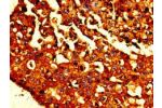 Immunohistochemistry of paraffin-embedded human breast cancer using CSB-PA06239A0Rb at dilution of 1:100