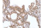 The image on the left is immunohistochemistry of paraffin-embedded Human colon cancer tissue using CSB-PA062537(CTBP2 Antibody) at dilution 1/25, on the right is treated with fusion protein. (Original magnification: 