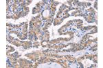 The image on the left is immunohistochemistry of paraffin-embedded Human thyroid cancer tissue using CSB-PA062845(AP1B1 Antibody) at dilution 1/70, on the right is treated with synthetic peptide. (Original magnification: 