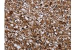 The image on the left is immunohistochemistry of paraffin-embedded Human prostate cancer tissue using CSB-PA063192(GALT Antibody) at dilution 1/40, on the right is treated with fusion protein. (Original magnification: 