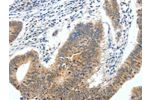 The image on the left is immunohistochemistry of paraffin-embedded Human colon cancer tissue using CSB-PA063282(ECE2 Antibody) at dilution 1/40, on the right is treated with fusion protein. (Original magnification: 