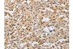 The image on the left is immunohistochemistry of paraffin-embedded Human thyroid cancer tissue using CSB-PA063322(AMZ2 Antibody) at dilution 1/40, on the right is treated with fusion protein. (Original magnification: 