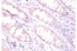 Immunohistochemistry of paraffin-embeded human colorectal carcinoma using CSB-PA06339A0Rb at dilution of 1:100