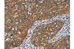 The image on the left is immunohistochemistry of paraffin-embedded Human cervical cancer tissue using CSB-PA063513(FZD1 Antibody) at dilution 1/15, on the right is treated with synthetic peptide. (Original magnification: 