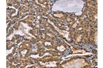 The image on the left is immunohistochemistry of paraffin-embedded Human thyroid cancer tissue using CSB-PA063633(EPHB6 Antibody) at dilution 1/50, on the right is treated with fusion protein. (Original magnification: 