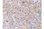 The image on the left is immunohistochemistry of paraffin-embedded Human liver cancer tissue using CSB-PA063689(GAS1 Antibody) at dilution 1/20, on the right is treated with synthetic peptide. (Original magnification: 